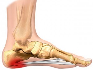 Foot Pain Got You Down? 3 plantar fascia 13